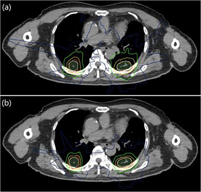 Dosimetric and biological comparisons of single planning and double plannings for bilateral lung cancer SBRT planning based on the Cyber-Knife system